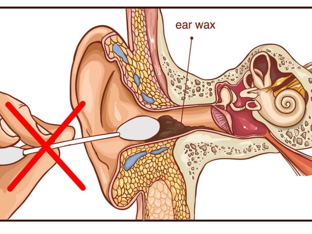 Ear Wax: कान का मैल करने वालों  हो जाओ सावधान, चुकानी पड़ सकती है भारी कीमत। कैसै करें कान के मैल की सफाई जान लें!