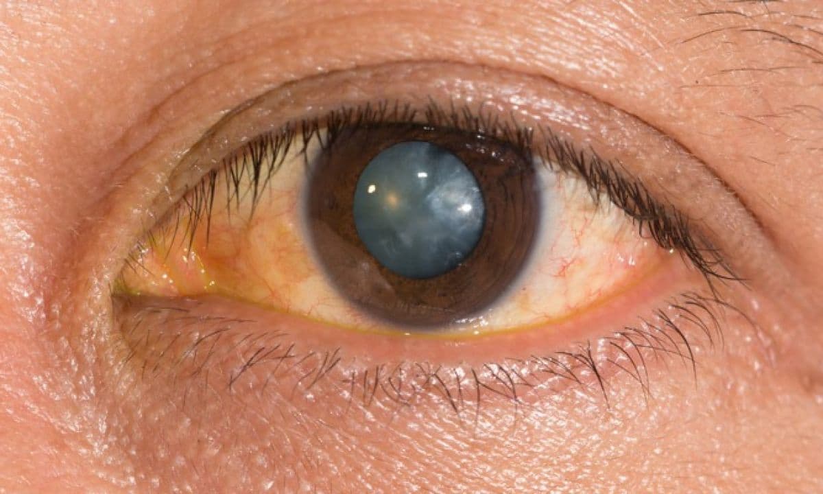 काला मोतियाबिंद ,Glaucoma क्या जाने इसका उपचार
