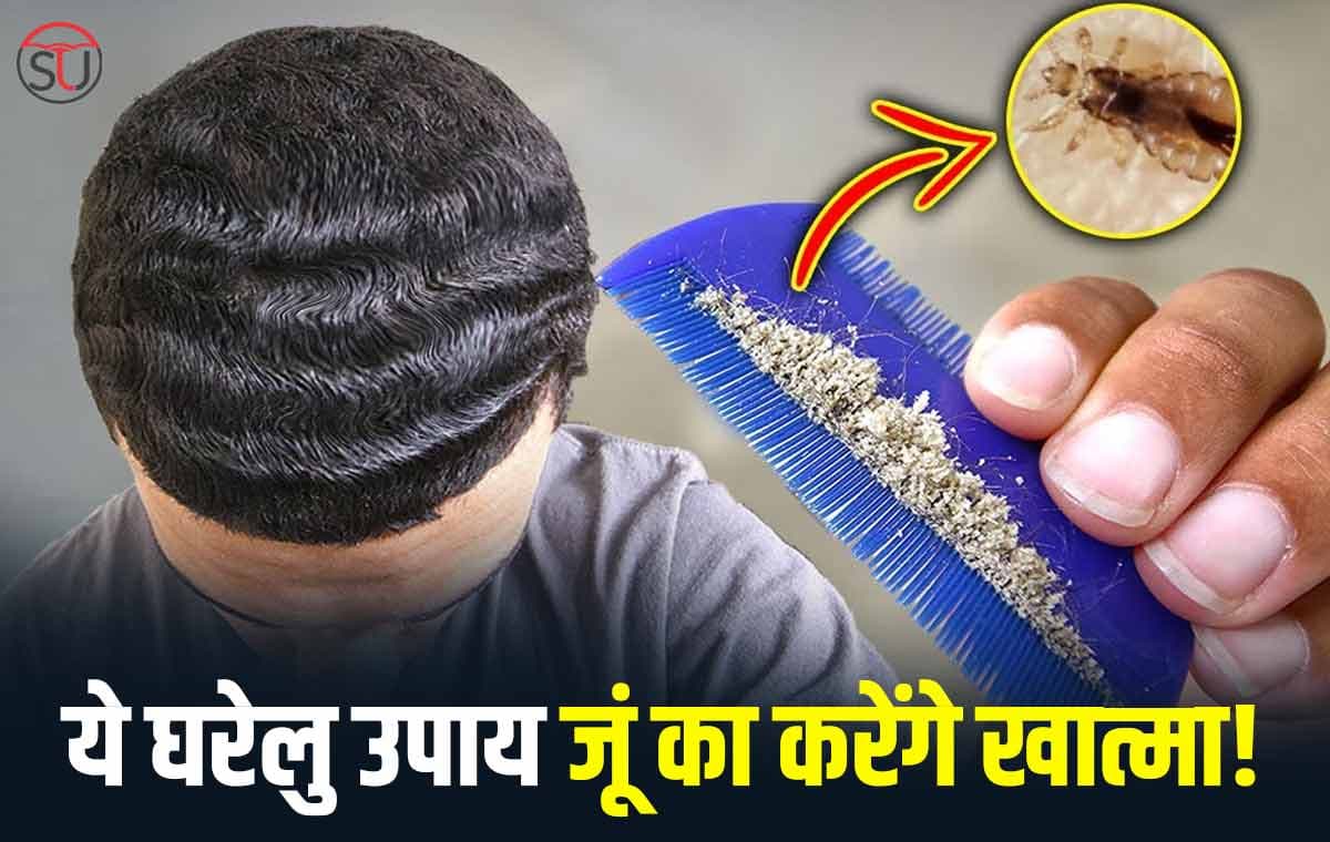 Hair Lice की समस्या होगी छूमंतर, घरेलु उपाय से होगा जूं का हमेशा के लिए खात्मा!!