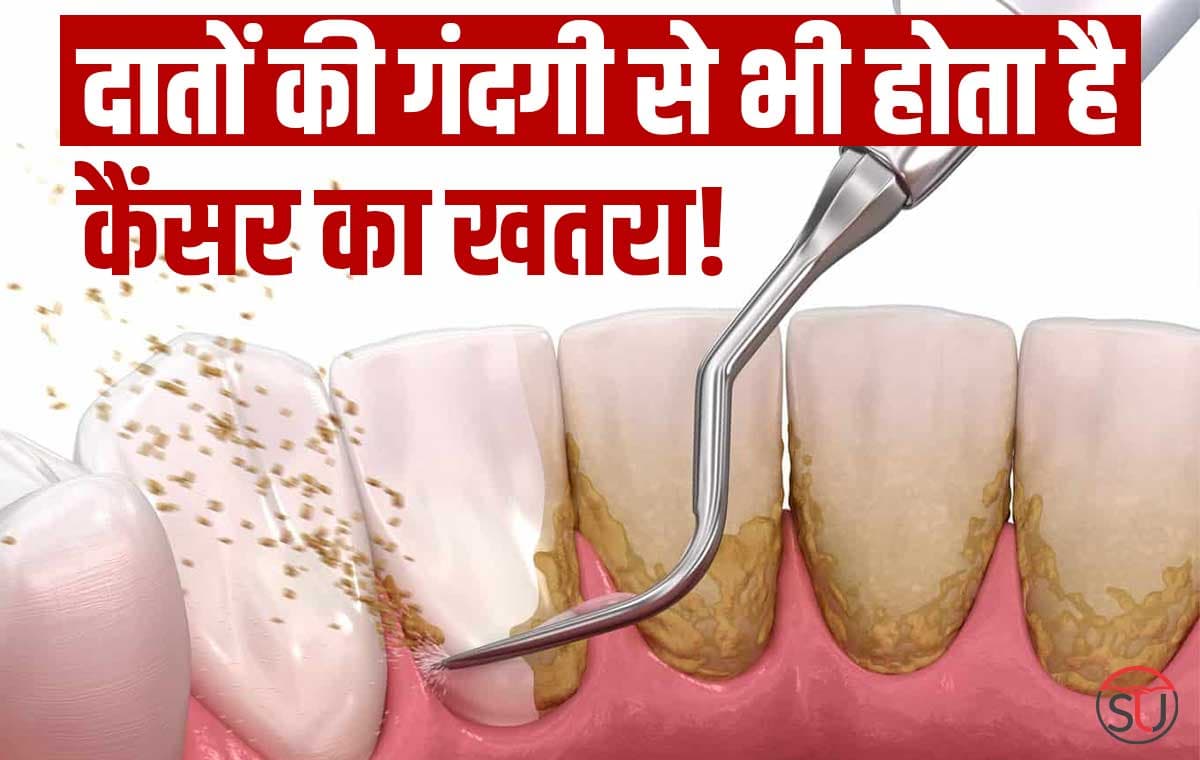 Tooth Cleaning: दातों को साफ करना है जरुरी तभी बनेगी कैंसर जैसी बीमारियों से दूरी!!