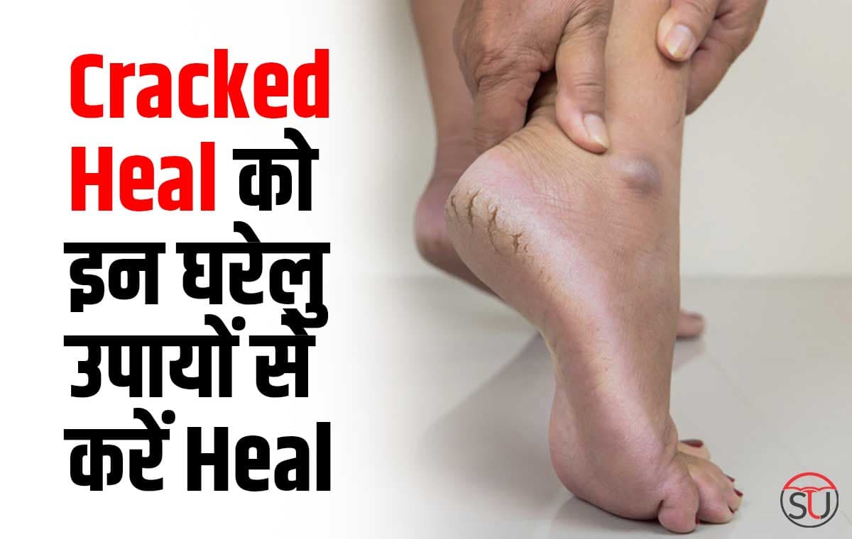 क्यों फटती है पैरों की एंड़िया? इन्हें दें घरेलु नुस्खों से आरामदायक एहसास!!