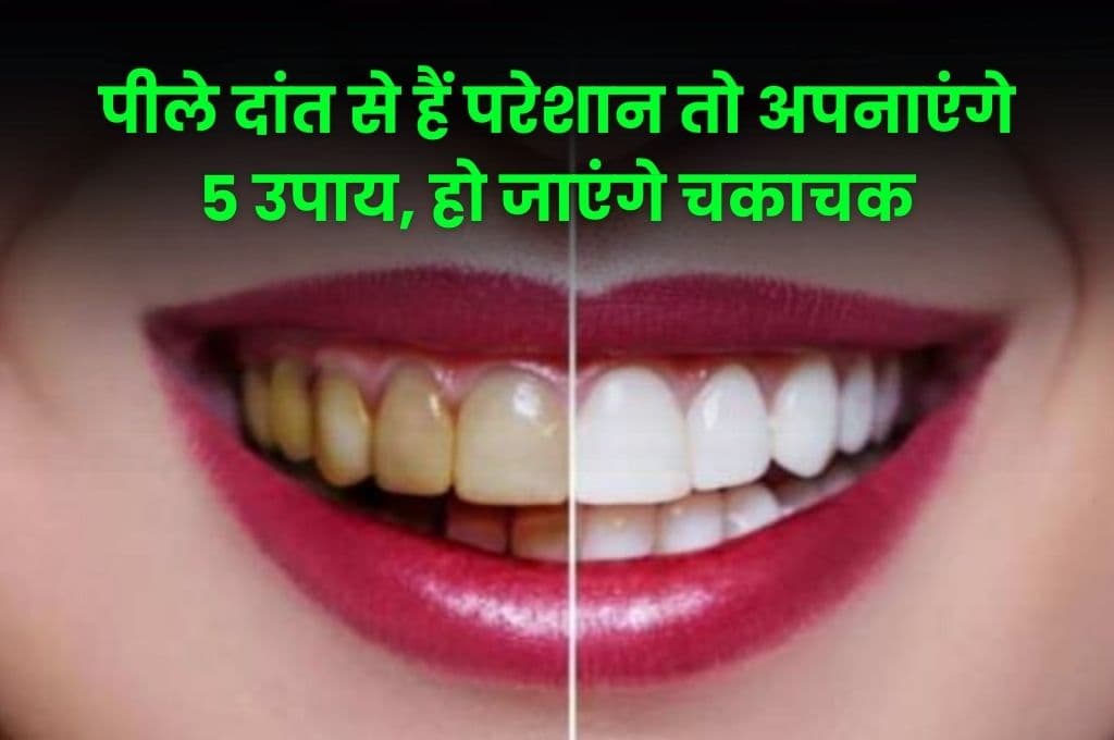 Health Tips: पीले दांत से हैं परेशान तो अपनाएंगे 5 उपाय, हो जाएंगे चकाचक