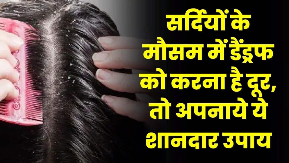 Winter Hair Care Tips: सर्दियों के मौसम में डैंड्रफ को करना है दूर, तो अपनाये ये शानदार उपाय