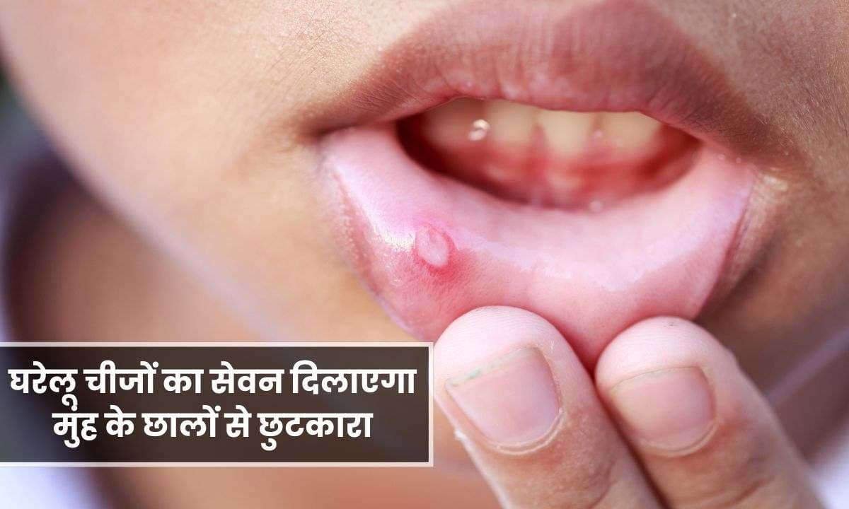 Mouth Ulcers: इन 7 घरेलू चीजों का सेवन दिलाएगा मुंह के छालों से छुटकारा