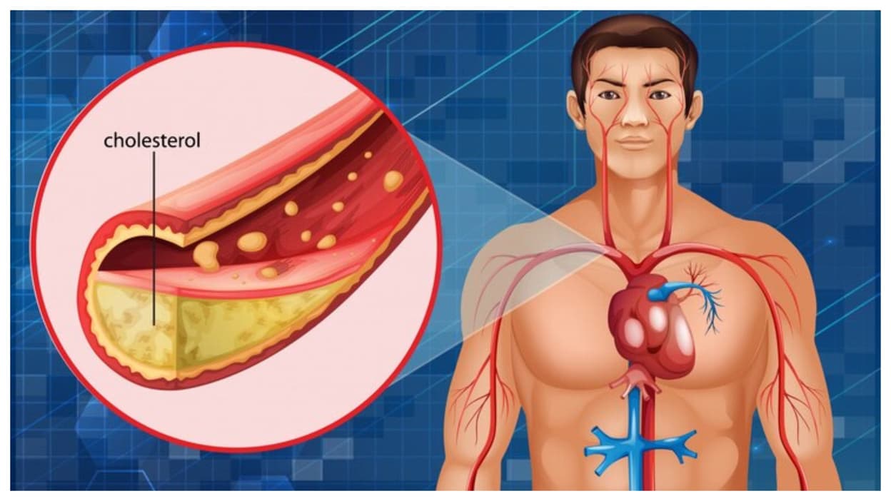 Cholesterol : बड़ी समस्या बनती जा रही कोलेस्ट्रॉल, जानें क्या है इसके पीछे वजहें
