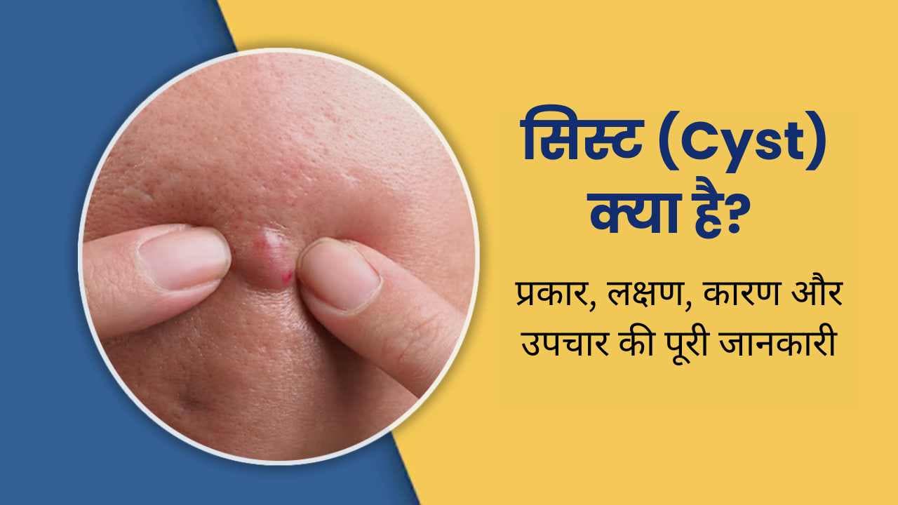 सिस्ट (Cyst) क्या है? प्रकार, लक्षण, कारण और उपचार की पूरी जानकारी