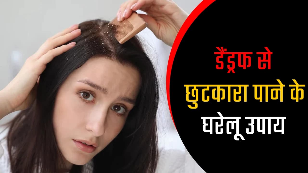 डैंड्रफ से छुटकारा पाने के घरेलू उपाय: सर्दियों में बालों को मजबूत और स्वस्थ रखें डैंड्रफ से छुटकारा पाने के घरेलू उपाय: सर्दियों में बालों को मजबूत और स्वस्थ रखें