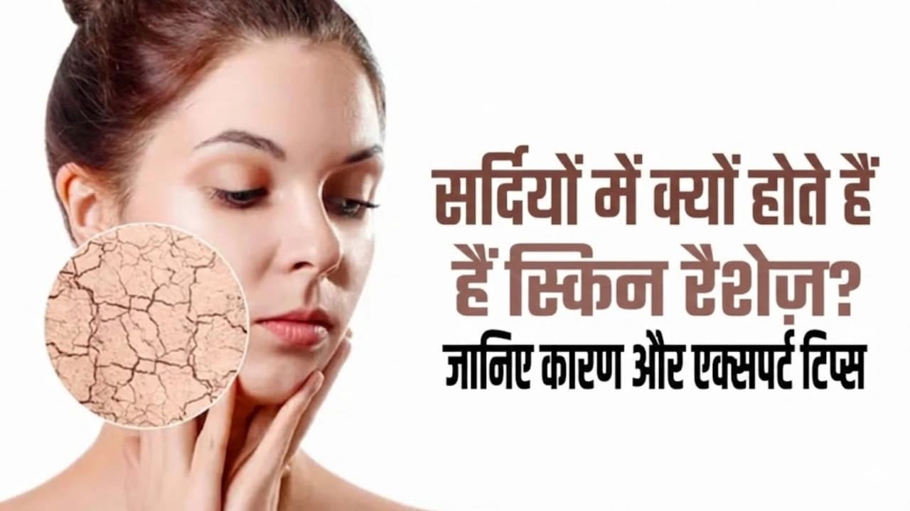सर्दियों में क्यों होते हैं स्किन रैशेज़? जानिए कारण और एक्सपर्ट टिप्स सर्दियों में क्यों होते हैं स्किन रैशेज़? जानिए कारण और एक्सपर्ट टिप्स