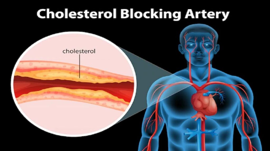 LDL Cholesterol
