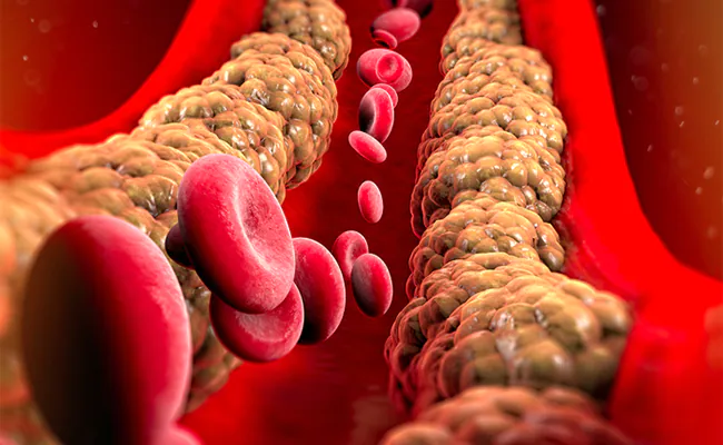 LDL Cholesterol