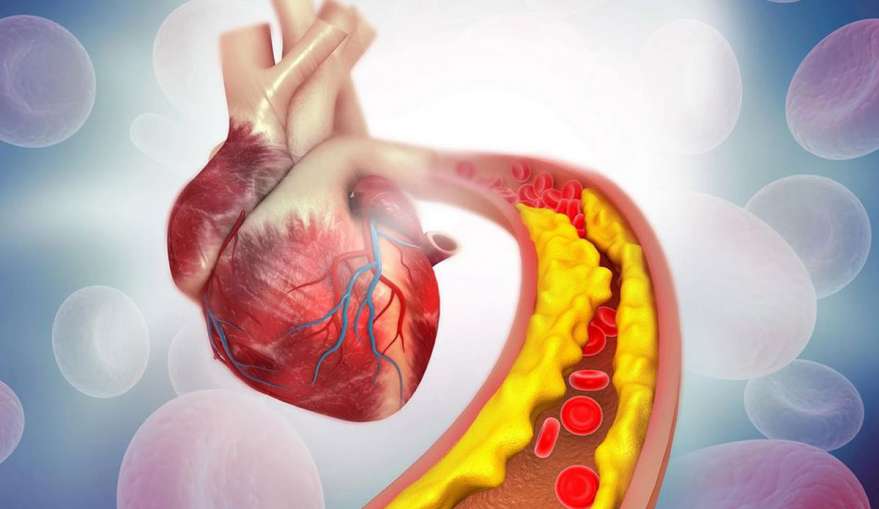 LDL Cholesterol