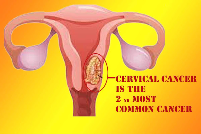 Cervical Cancer
