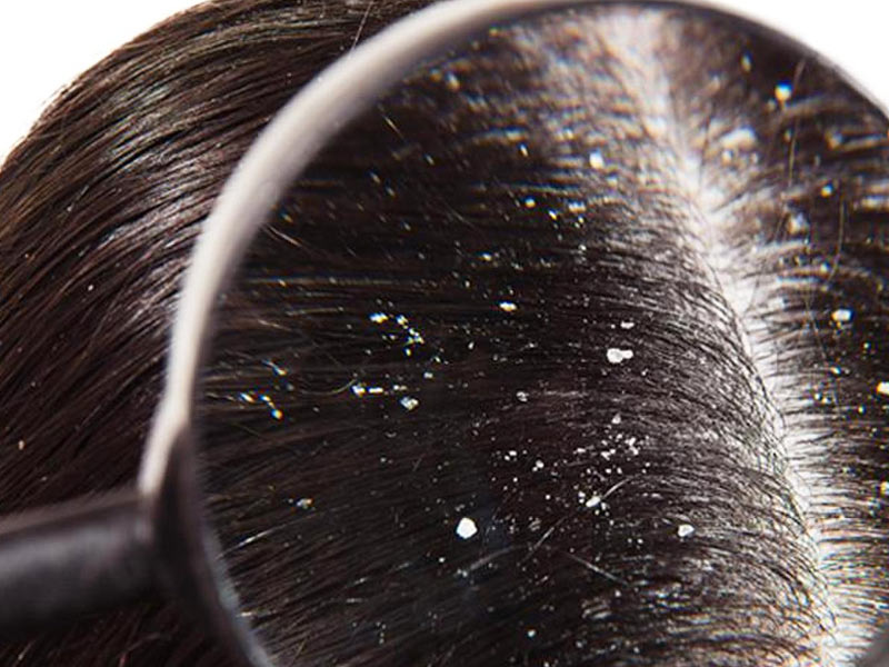 Dandruff