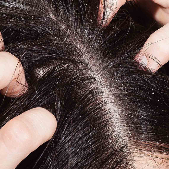 Dandruff