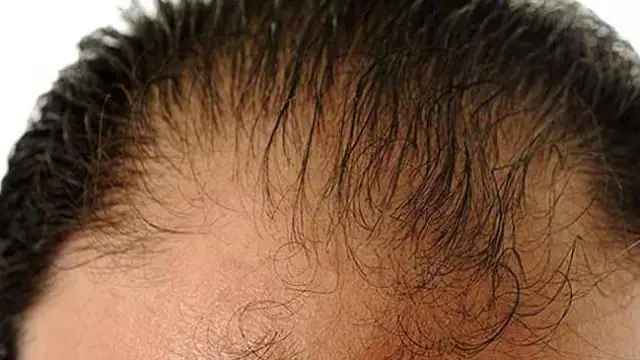 Hair Loss