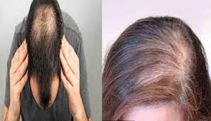 Hair Loss