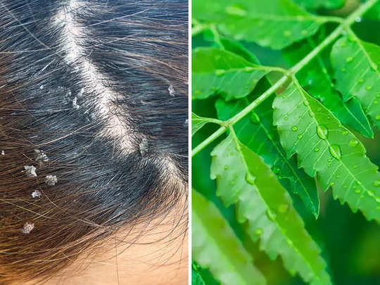 Dandruff