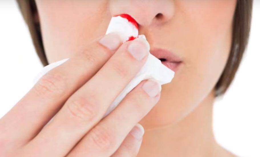 Nose bleeding