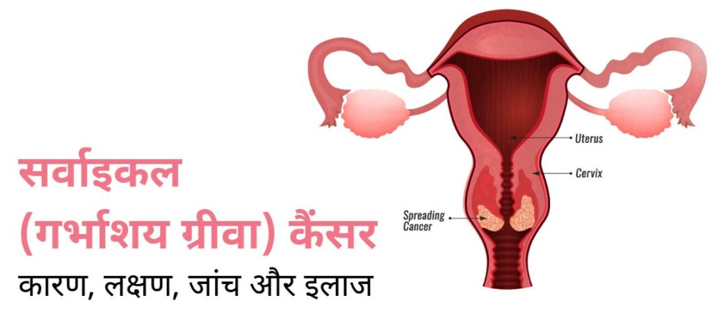 Cervical Cancer