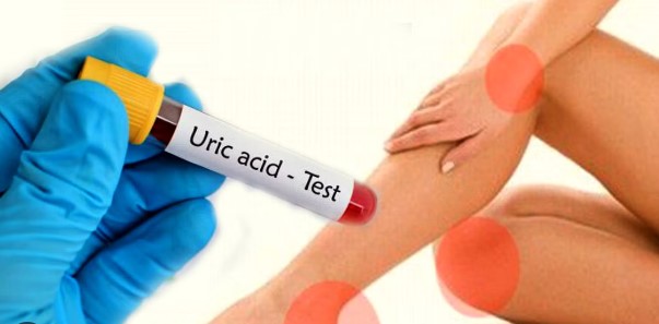 Uric Acid