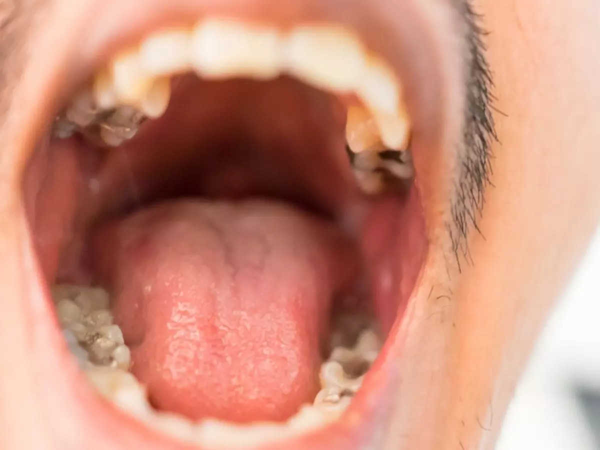 Oral Cancer