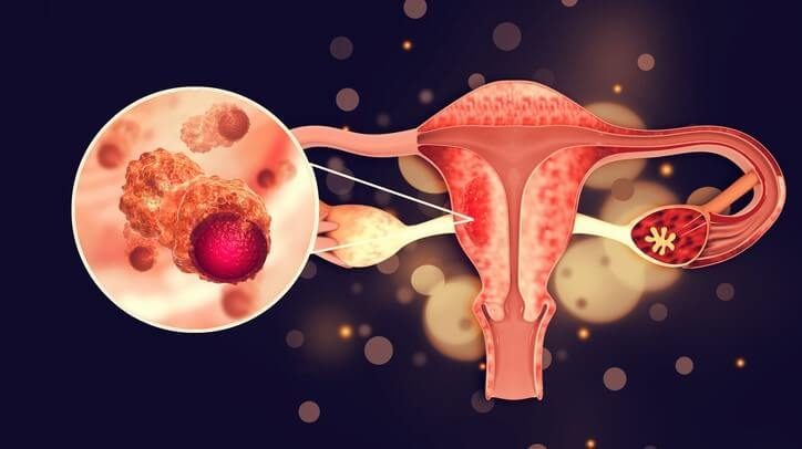 Ovarian cancer