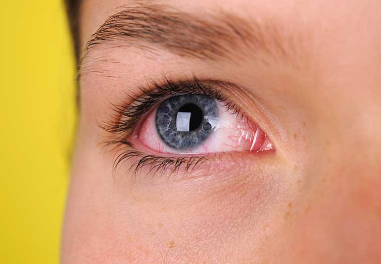 Red Eyes