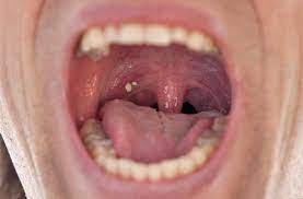 Tonsils