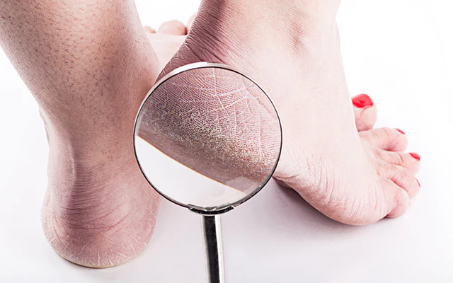 crack heel
