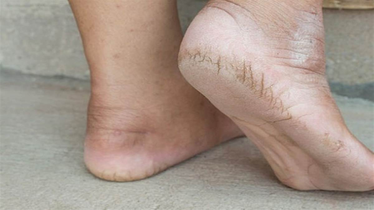 crack heel
