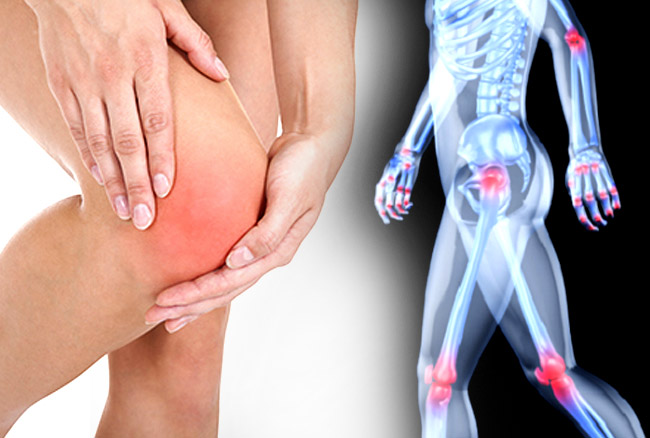 Arthritis