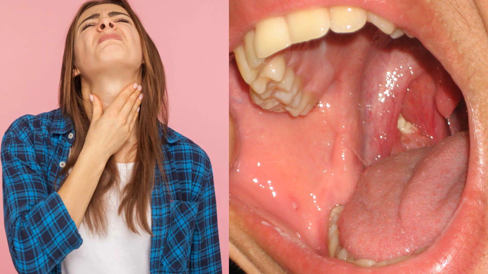 Tonsils