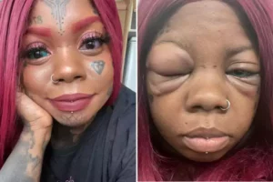 Woman tattooed her eyeballs and goes blind.