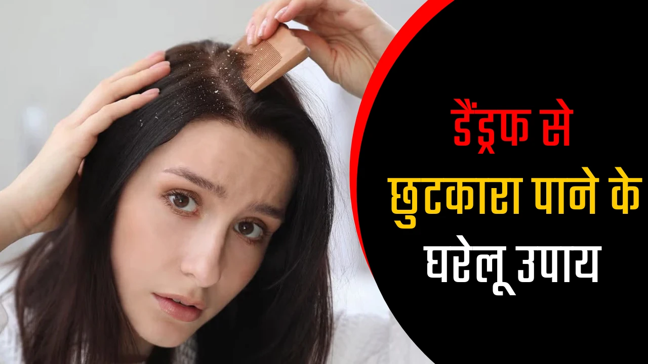 डैंड्रफ से छुटकारा पाने के घरेलू उपाय: सर्दियों में बालों को मजबूत और स्वस्थ रखें