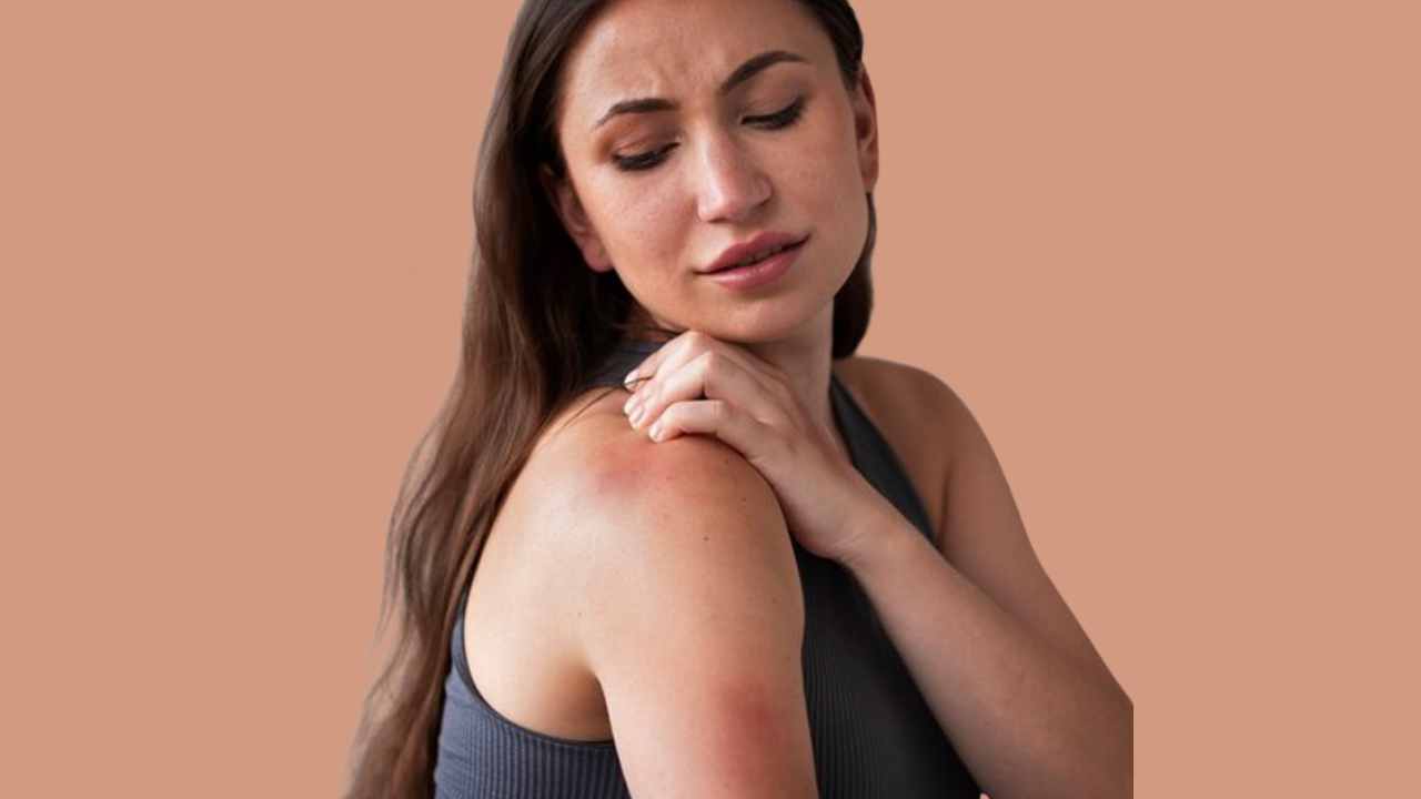  घमौरियों 