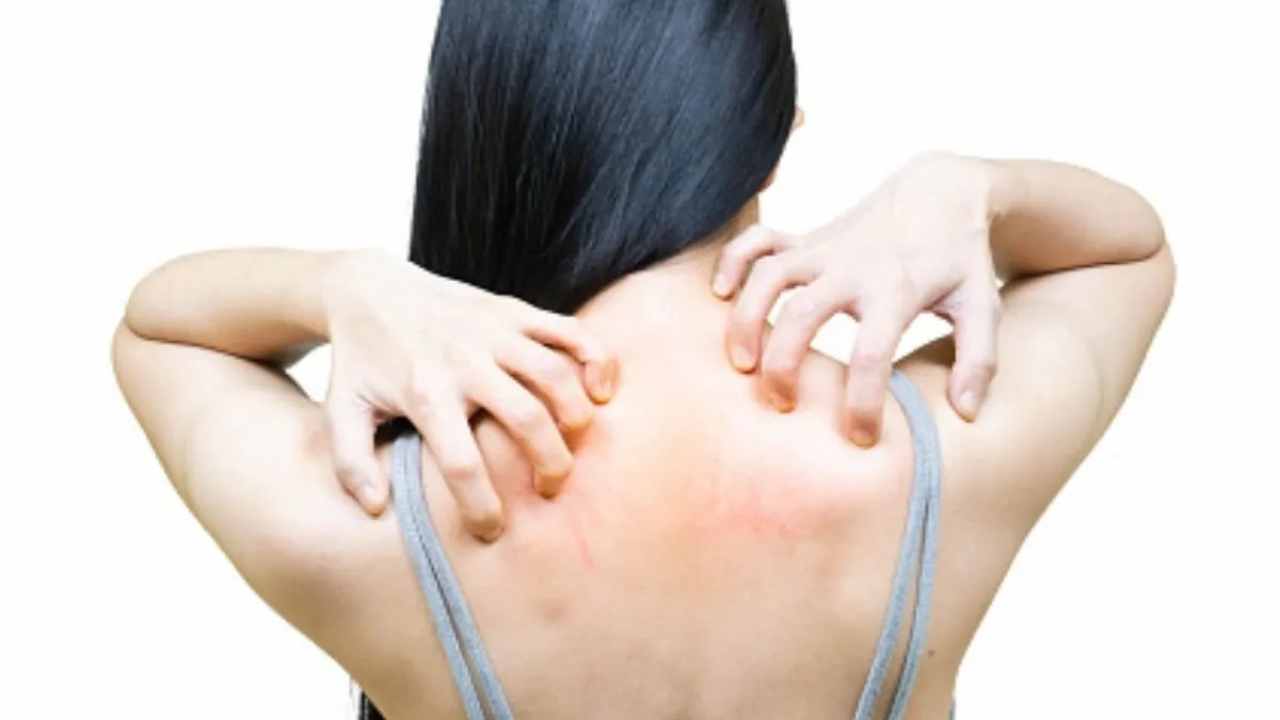  घमौरियों 